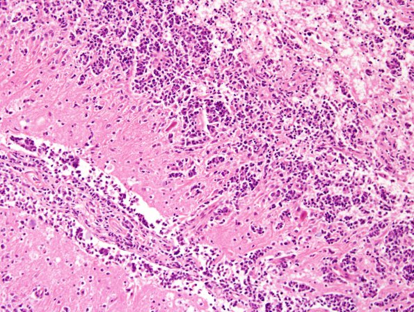 5C5 Lymphoma, secondary (Case 5) H&E 1.jpg