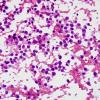 6A Lymphoma, secondary (Case 6) smear 1.jpg