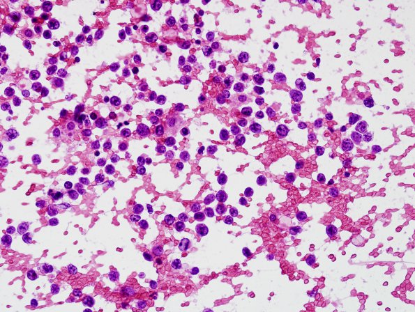 6A Lymphoma, secondary (Case 6) smear 1.jpg