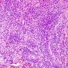 6B1 Lymphoma, secondary (Case 6) H&E 3.jpg