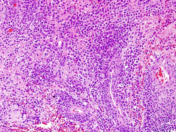 6B1 Lymphoma, secondary (Case 6) H&E 3.jpg