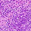 6B2 Lymphoma, secondary (Case 6) H&E 1.jpg