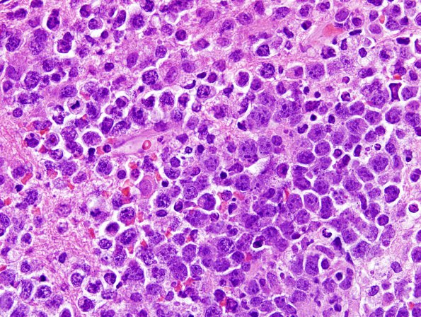 6B2 Lymphoma, secondary (Case 6) H&E 1.jpg