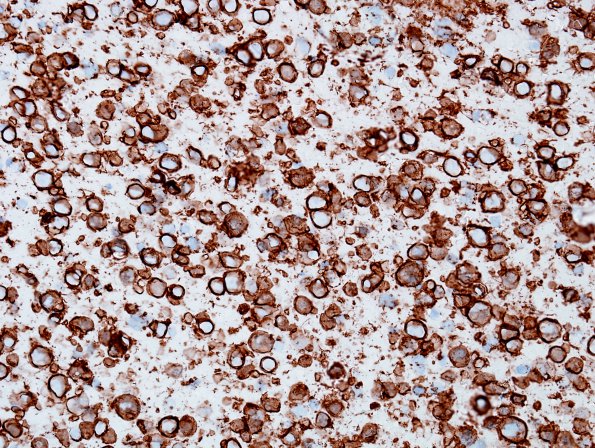 6C1 Lymphoma, secondary (Case 6) CD20 2.jpg