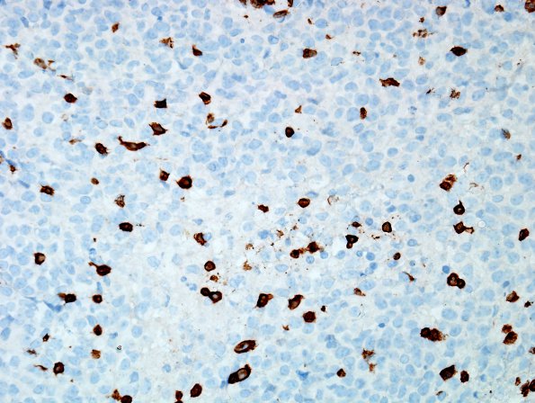 6C3 Lymphoma, secondary (Case 6) CD3.jpg