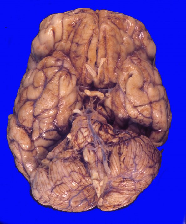 7A1 Lymphoma, secondary, HIV (Case 7) 5