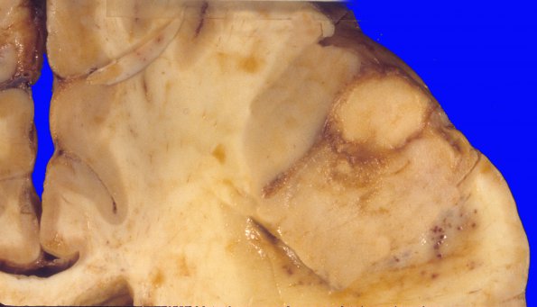 7A3 Lymphoma, secondary, HIV (Case 7) 1