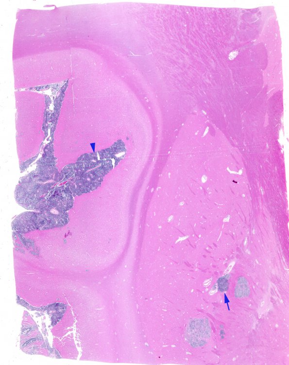 7B1 Lymphoma, secondary, HIV (Case 7) N10 2 copy