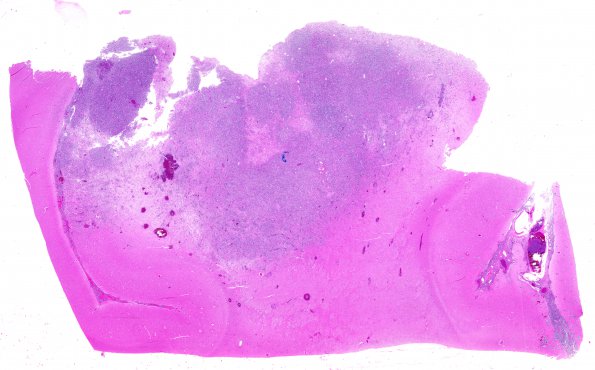 7B3 Lymphoma, secondary, HIV (Case 7) N1 2