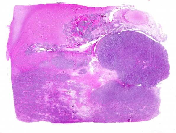 7B4 Lymphoma, secondary, HIV (Case 7) N11 WM