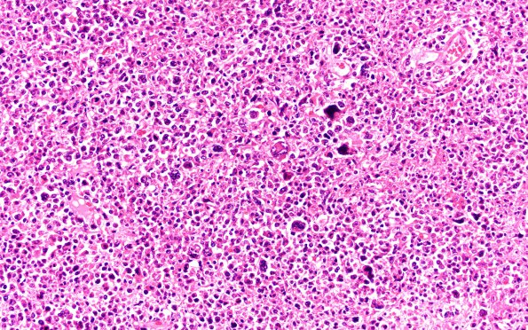 7B5 Lymphoma, secondary, HIV (Case 7) N11 20X