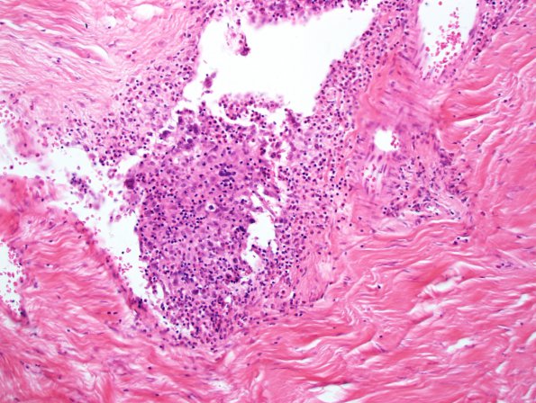 8A2 Lymphoma, Hodgkin's (Case 8) N15 H&E 7