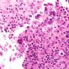 8A3 Lymphoma, Hodgkin's, dura (Case 8) N15 H&E 4