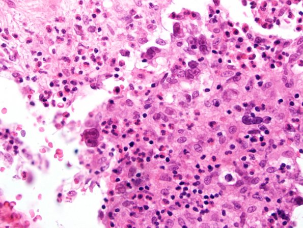 8A3 Lymphoma, Hodgkin's, dura (Case 8) N15 H&E 4