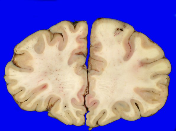 1A1 Lymphomatoid Granulomatosis (Case 1) 16