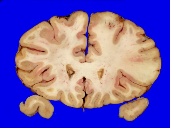 1A3 Lymphomatoid Granulomatosis (Case 1) 2