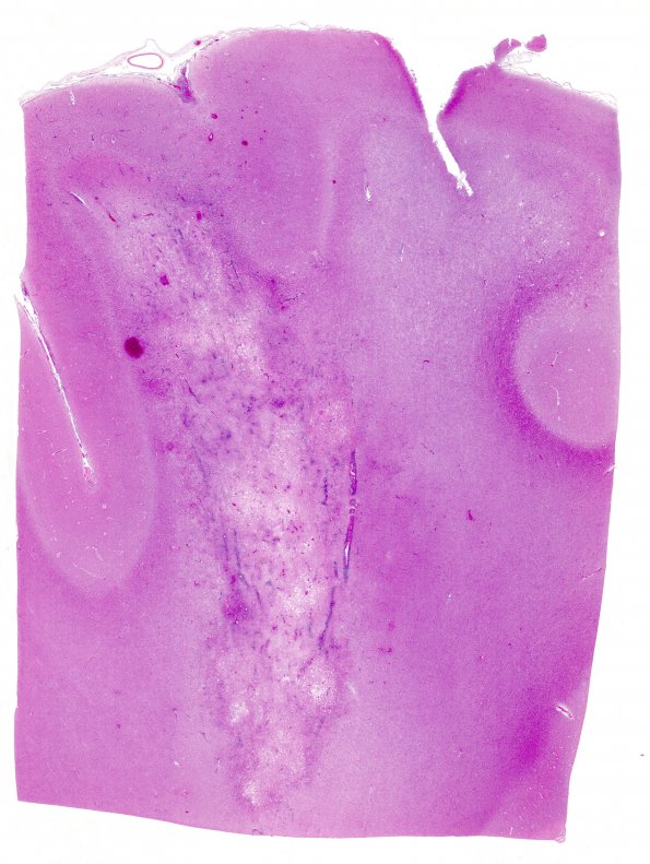 1B1 Lymphomatoid Granulomatosis (Case 1) H&E WM 1