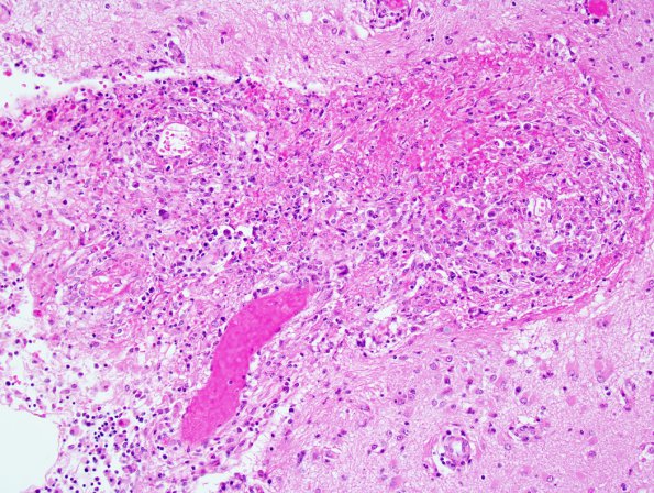 1B3 Lymphomatoid Granulomatosis (Case 1) 2