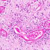 1B4 Lymphomatoid Granulomatosis (Case 1) 5