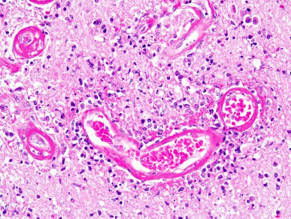 1B4 Lymphomatoid Granulomatosis (Case 1) 5