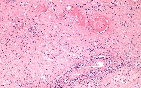 1B5 Lymphomatoid Granulomatosis (Case 1) H&E 20X