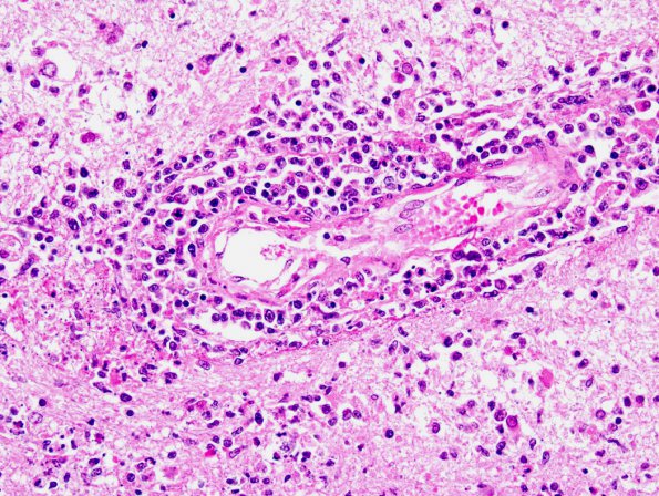 1B6 Lymphomatoid Granulomatosis (Case 1) 6