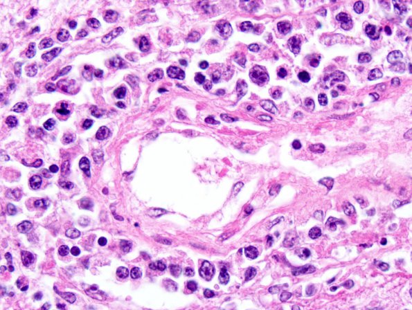 1B7 Lymphomatoid Granulomatosis (Case 1) 7.