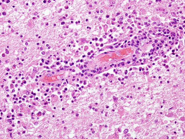 1B8 Lymphomatoid Granulomatosis (Case 1) H&E 5