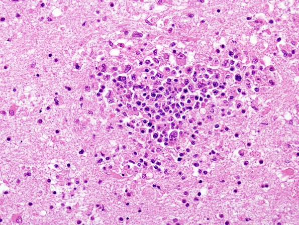 1B9 Lymphomatoid Granulomatosis (Case 1) H&E 6