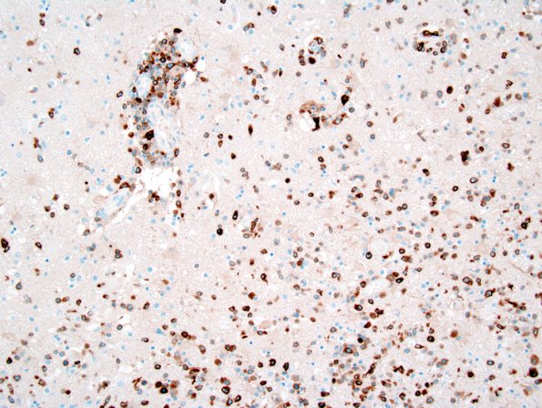  1D2 Lymphomatoid Granulomatosis (Case 1) CD79a 1