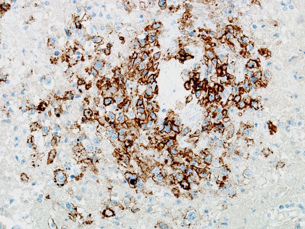 1D3 Lymphomatoid Granulomatosis (Case 1) CD79 1