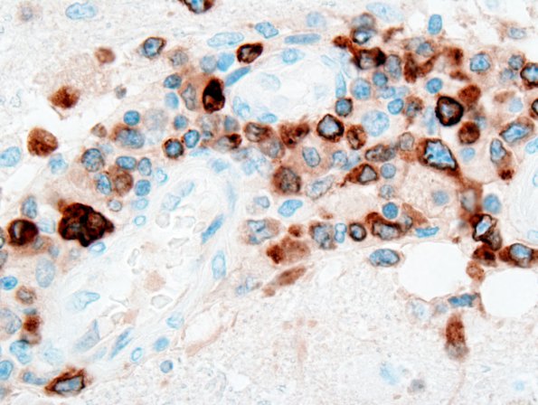  1D5 Lymphomatoid Granulomatosis (Case 1) CD79a 2