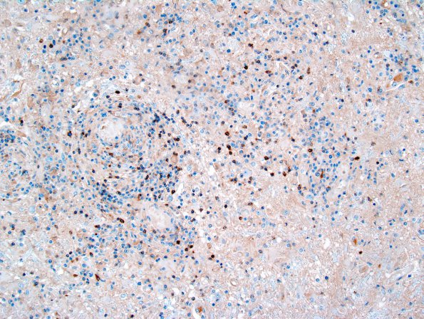  1E2 Lymphomatoid Granulomatosis (Case 1) CD3 1