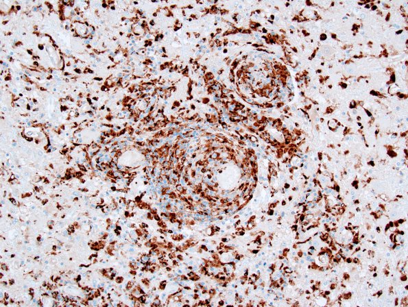 1F1 Lymphomatoid Granulomatosis (Case 1) CD68 2