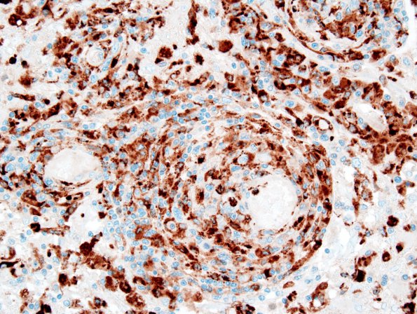 1F2 Lymphomatoid Granulomatosis (Case 1) CD68 3