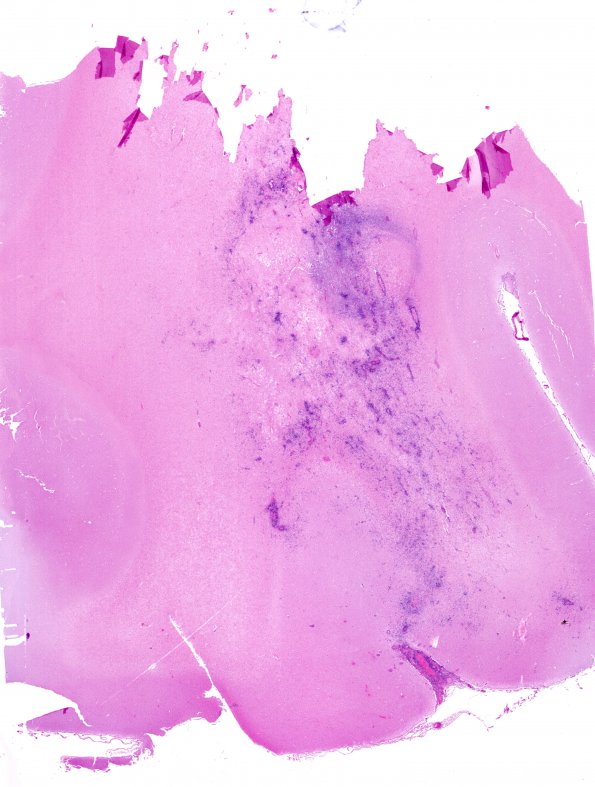 1G1 Lymphomatoid Granulomatosis (Case 1) EBER ISH whole mount