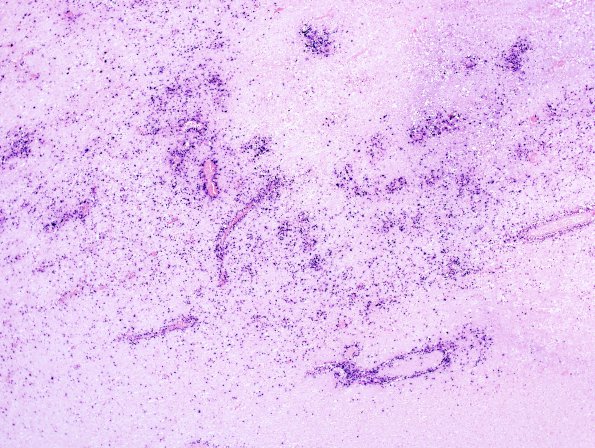 1G2 Lymphomatoid Granulomatosis (Case 1) EB ISH 1