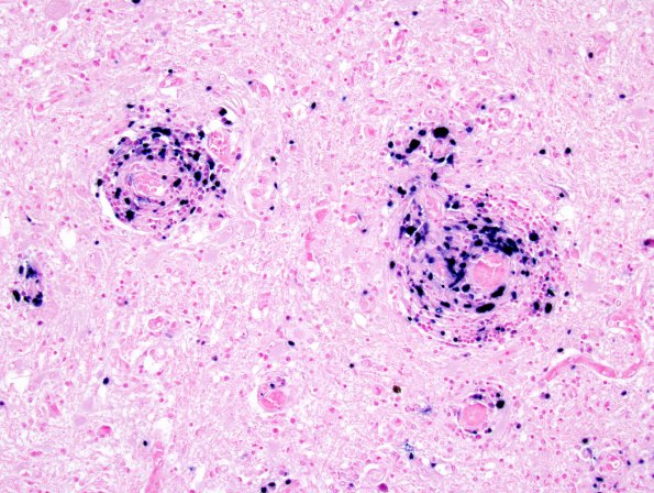 1G3 Lymphomatoid Granulomatosis (Case 1) EBER 2