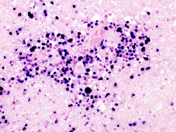 1G4 Lymphomatoid Granulomatosis (Case 1) EBER ISH 2