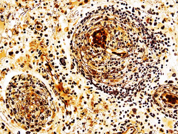 1H1 Lymphomatoid Granulomatosis (Case 1) Retic 1