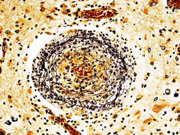 1H2 Lymphomatoid Granulomatosis (Case 1) Retic 2