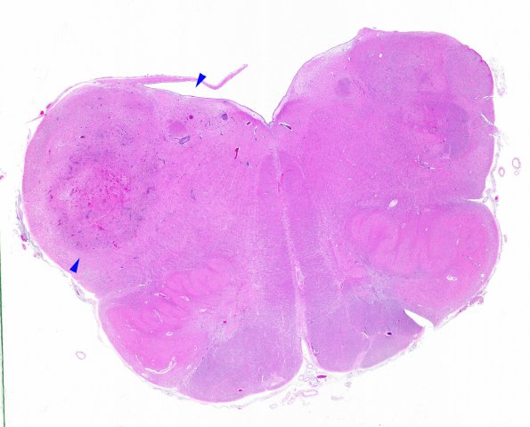 1K2 LYG (Case 1) Medulla N8 H&E WM copy