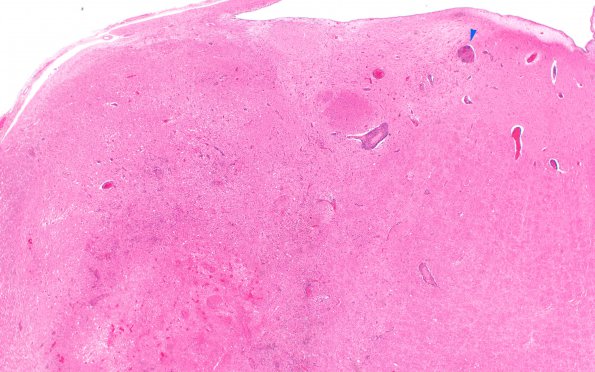 1K4 LYG Medulla N8 (Case 1) H&E WM 2X 2 copy