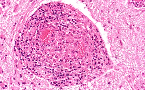 1K5 LYG Medulla N8 (Case 1) H&E WM 40X 2