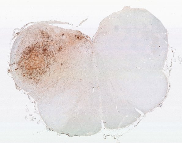 1K8 LYG (Case 1) Medulla N8 H&E WM