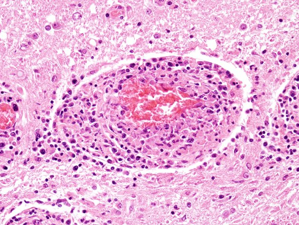 1M10 Lymphomatoid granulomatosis (Case 1) H&E 11