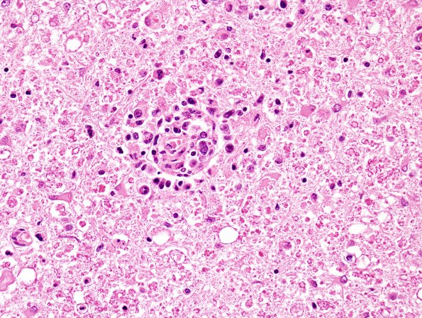 1M11 Lymphomatoid granulomatosis (Case 1) H&E 12