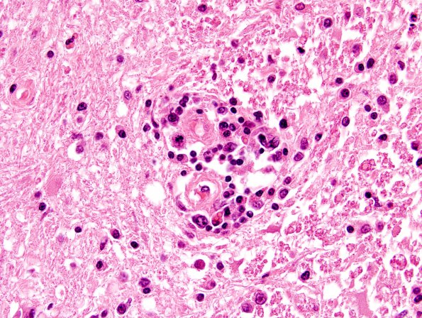 1M9 Lymphomatoid granulomatosis (Case 1) H&E 6