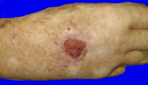 1N1 Lymphomatoid Granulomatosis skin (Case 1) 01