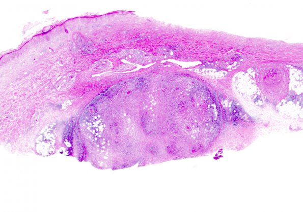 1N2 Lymphomatoid Granulomatosis (Case 1) H&E skin WM 1B